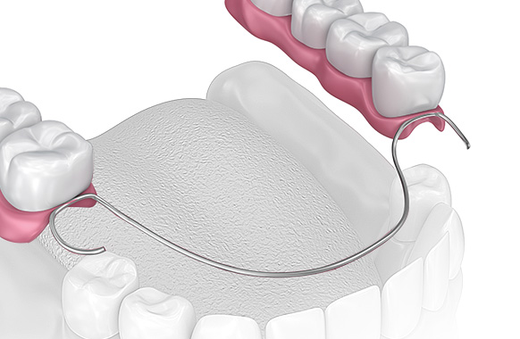 Partial Dentures